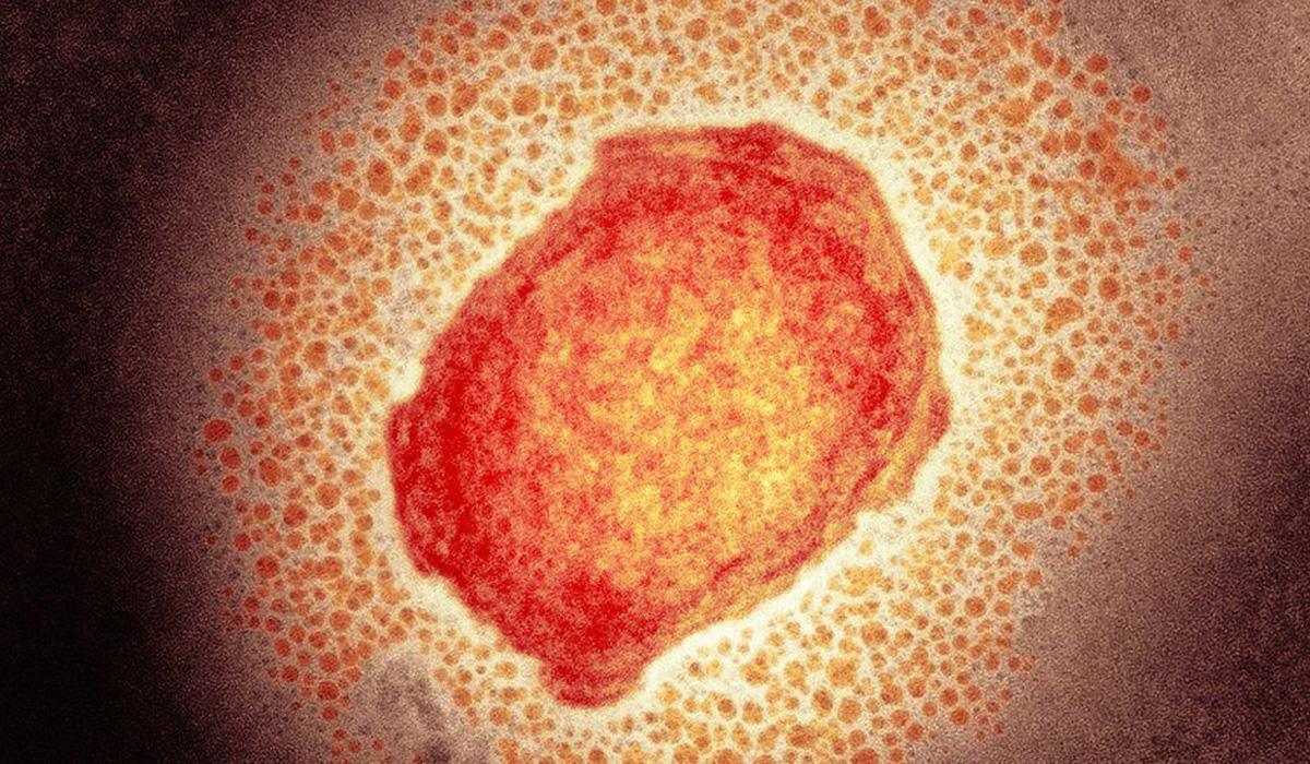Monkeypox virus